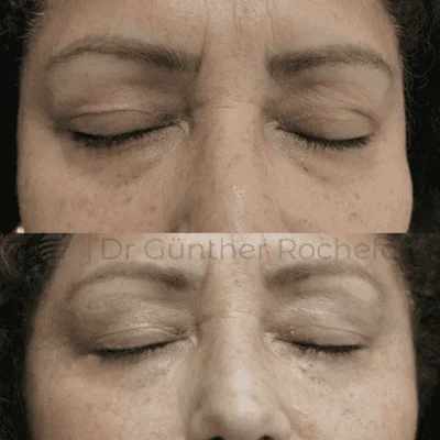 Blefaroplastia laser antes y despues