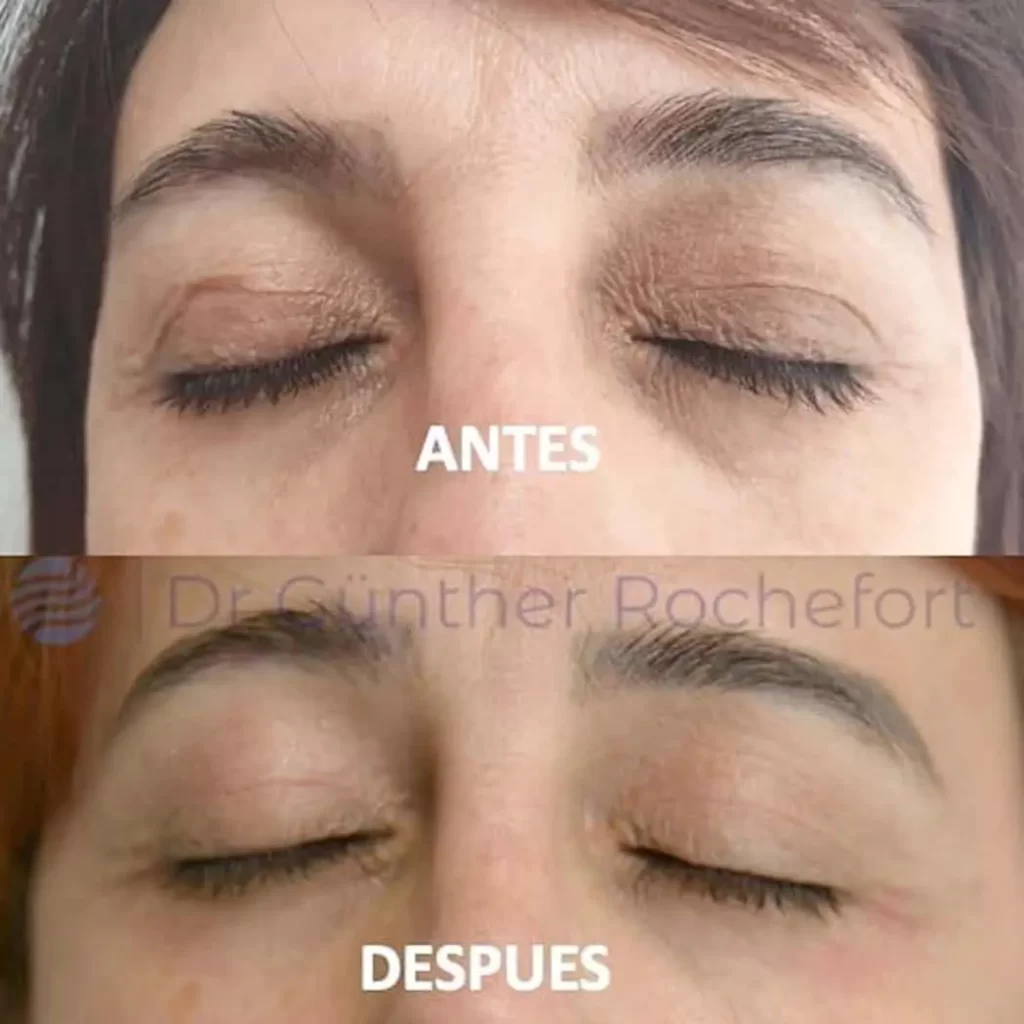 blefaroplastia antes y despues